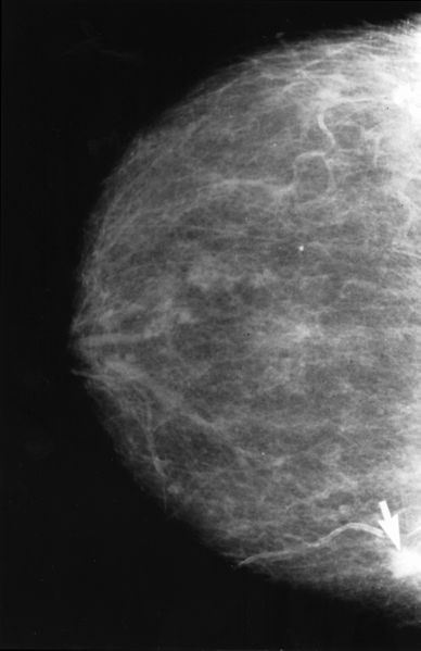 https://www.deingenieur.nl/uploads/media/5ae87cb06fda5/388px-Mammogram_with_obvious_cancer.jpg